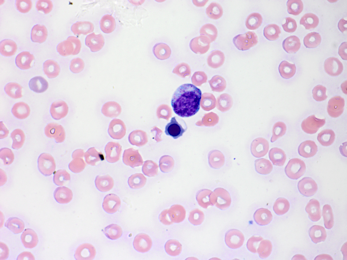 Peripheral blood smear showing myelophthisic picture